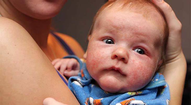 baby acne remedies